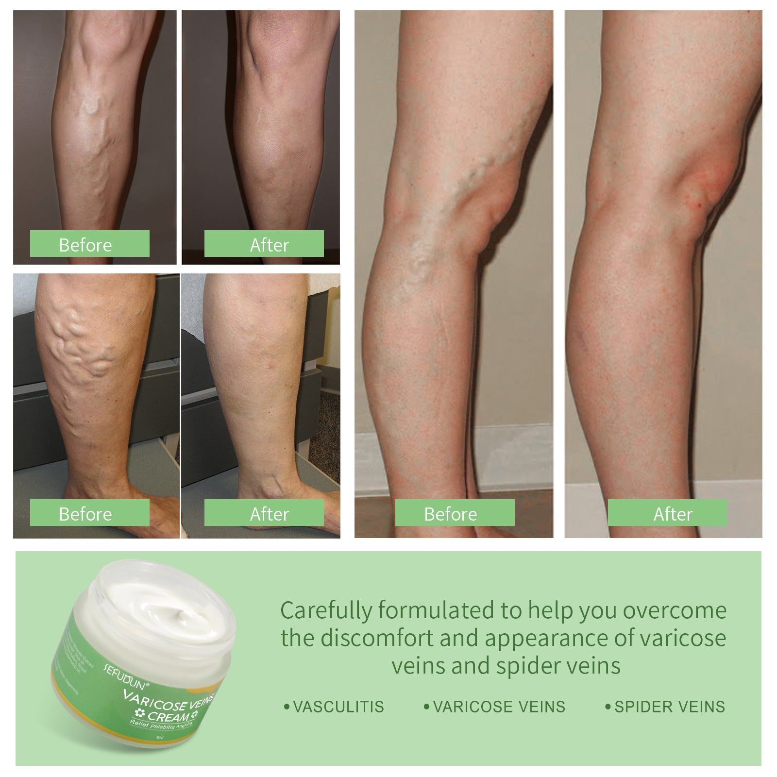 Varicose Cream Repair