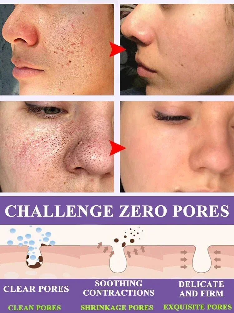 Removing Large Pore  Serum