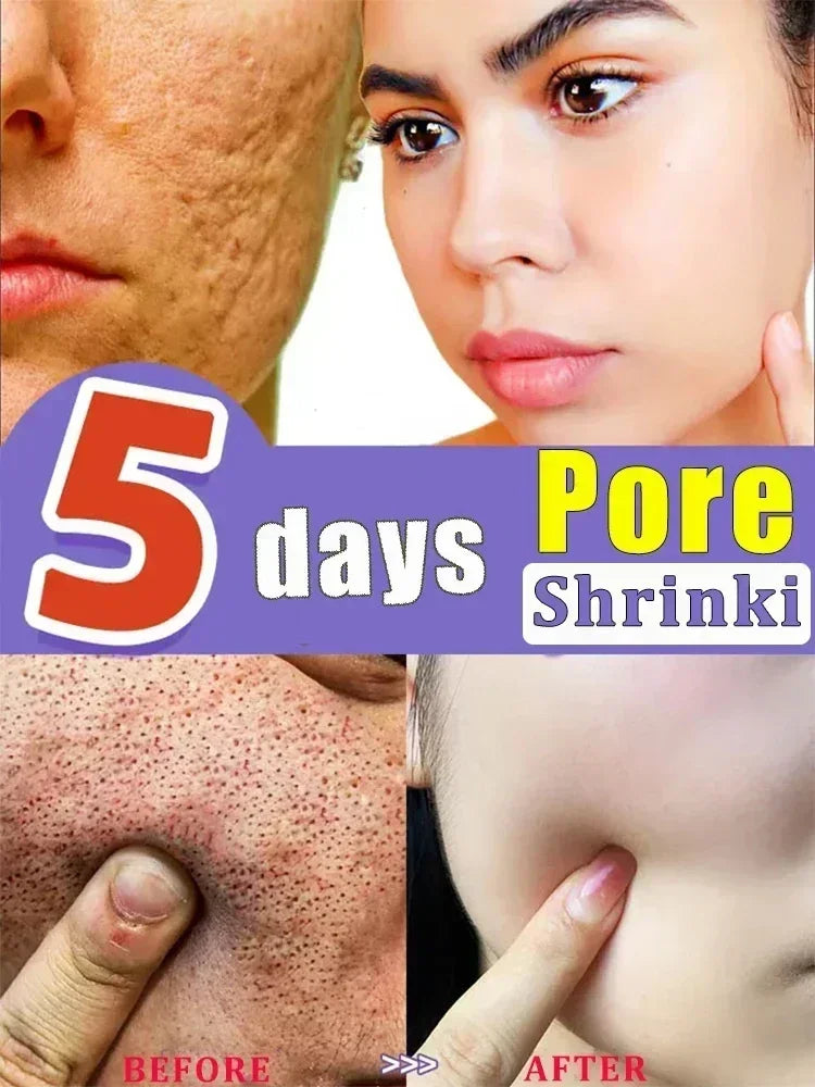 Removing Large Pore  Serum