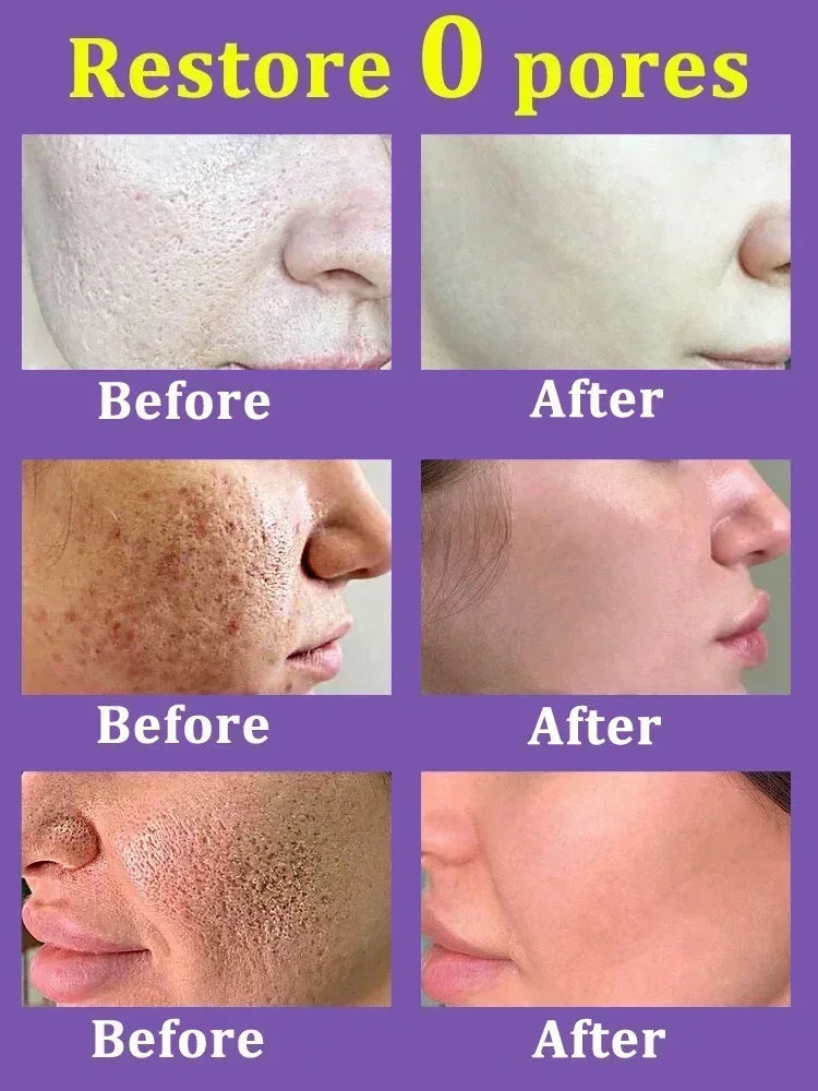 Removing Large Pore  Serum